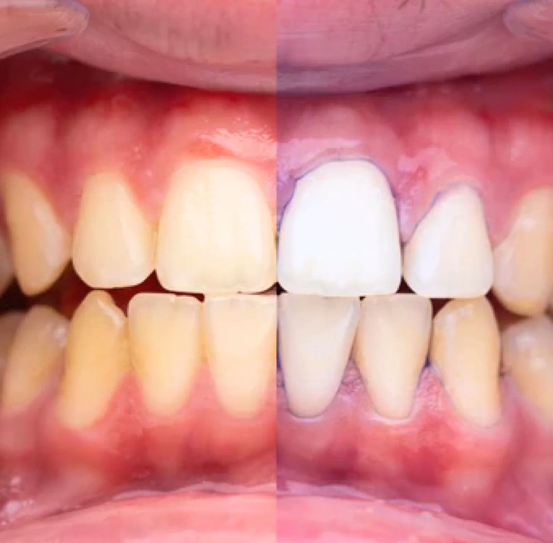 Sonrisa Brillante en Menos de 7 Días-Blanqueador Luxe Éclat