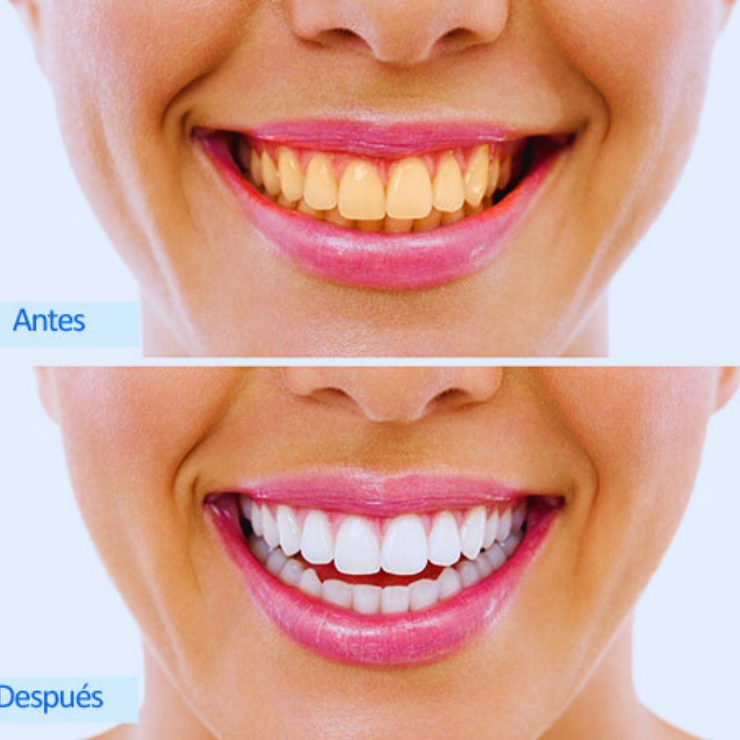 Sonrisa Brillante en Menos de 7 Días-Blanqueador Luxe Éclat
