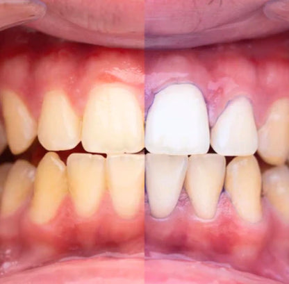 Sonrisa Brillante en Menos de 7 Días-Blanqueador Luxe Éclat